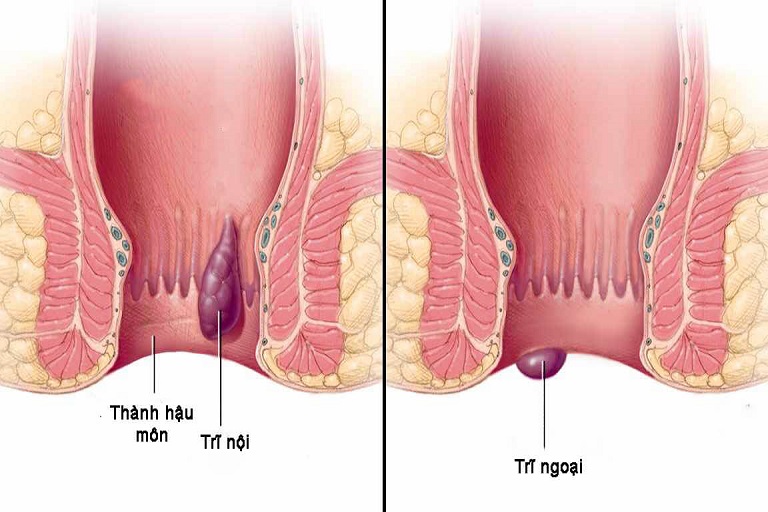 cắt trĩ có được bảo hiểm chi trả