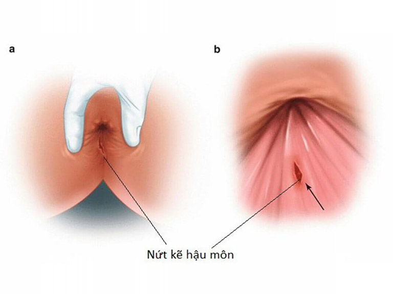 nứt kẽ hậu môn ở người