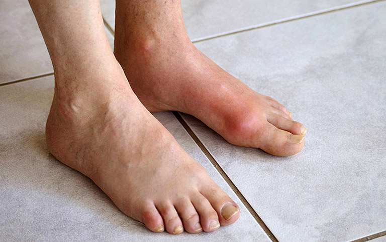 ngón chân cái bị sưng đau có phải bệnh gout không