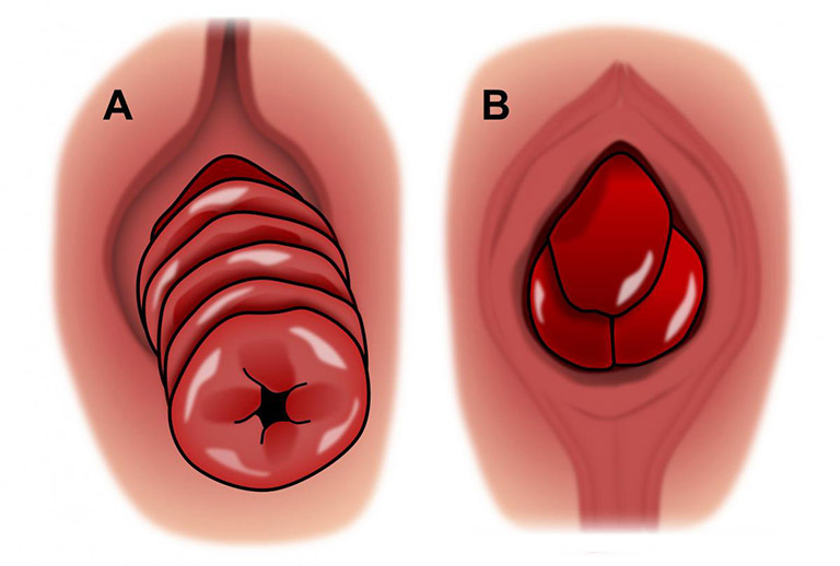 bị ngứa hậu môn