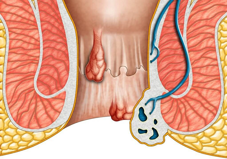 hiện tượng ngứa hậu môn