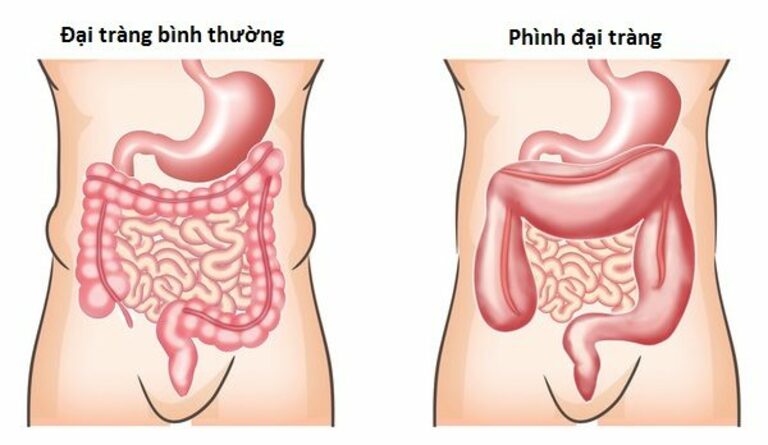 Phình đại tràng bẩm sinh có thể là một trong những nguyên nhân khiến trẻ sơ sinh 2 ngày không đi ngoài được