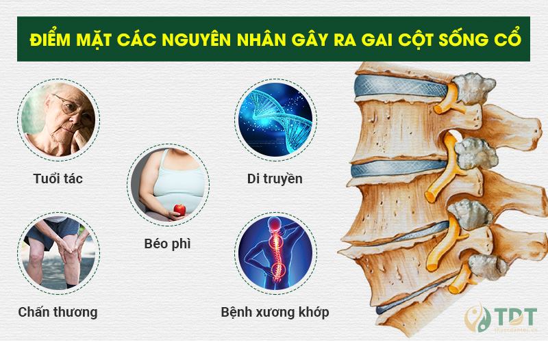 nguyên nhân gây ra gai cột sống cổ