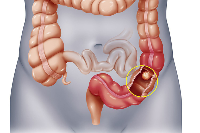 nguyên nhân gây xuất huyết tiêu hóa