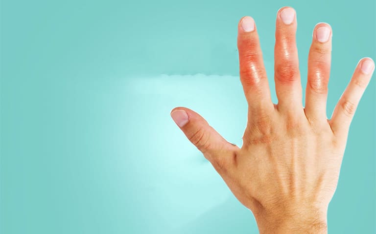Nổi cục ở đốt ngón tay có phải gout hay bệnh gì?