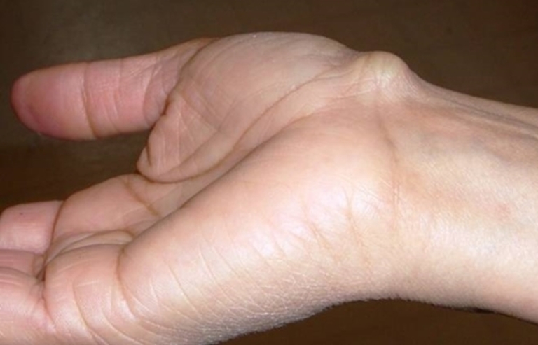 Nổi cục ở mu bàn tay là bị gì?