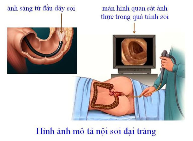 Hình ảnh được truyền về từ kỹ thuật nội soi đại tràng có thể giúp bác sĩ chẩn đoán bệnh chính xác hơn