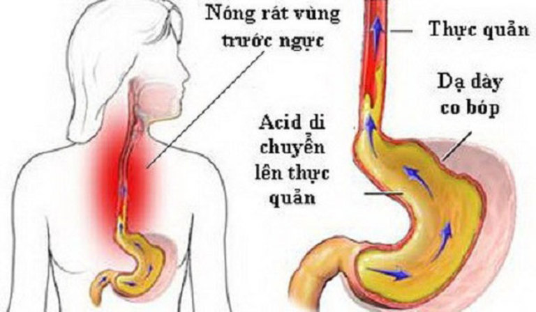 Thường xuyên ợ chua, ợ hơi hoặc ợ đắng là biểu hiện thường thấy của người đau dạ dày