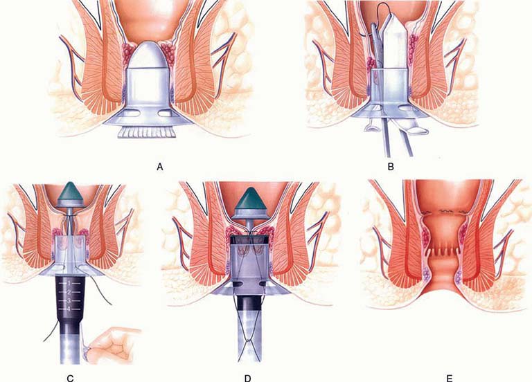 điều trị bệnh trĩ nặng bằng phương pháp longo