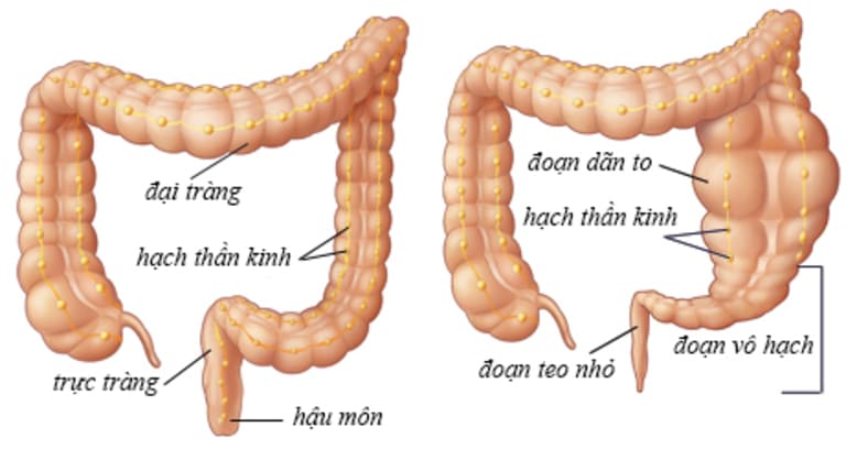 Mắc bệnh đại tràng phình to là một trong những nguyên nhân khiến trẻ sơ sinh bị táo bón lâu ngày không khỏi