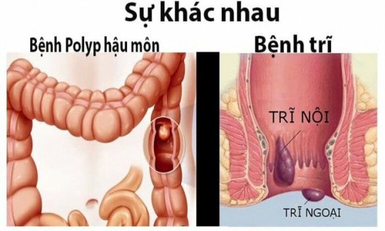 nguyên nhân phổ biến gây ra tình trạng đi ngoài ra máu tươi