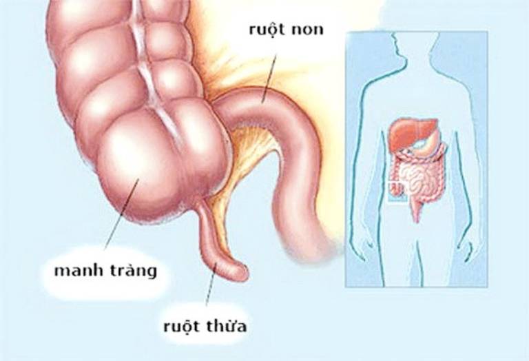 Ruột thừa là một cấu trúc hình ống nhỏ, dạng con giun, dài từ 2 - 20cm