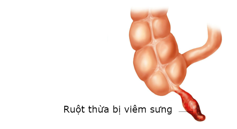 Nếu ruột thừa bị viêm sưng, gây đau bụng, bạn cần phải phẫu thuật cắt bỏ ruột thừa.