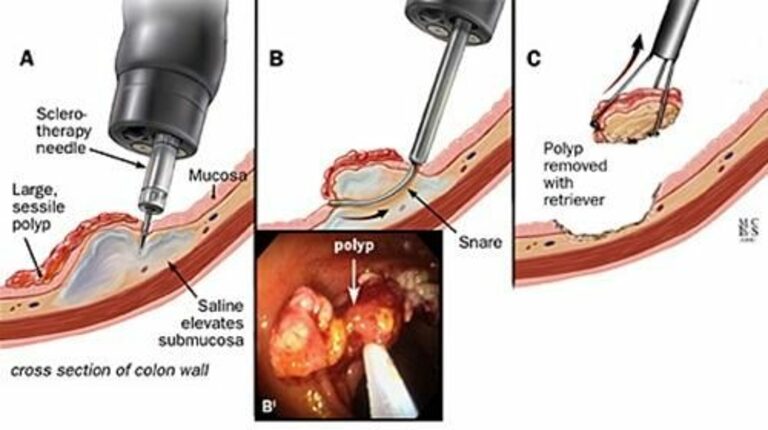 Sinh thiết polyp đại tràng