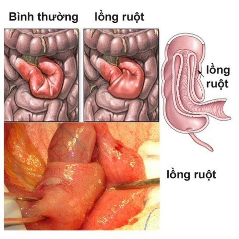 Tắc ruột do lồng ruột diễn biến nhanh và vô cùng nguy hiểm cho tính mạng của trẻ sơ sinh