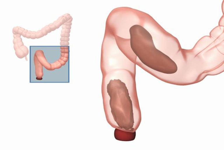 Táo bón theo đông y và các bài thuốc điều trị