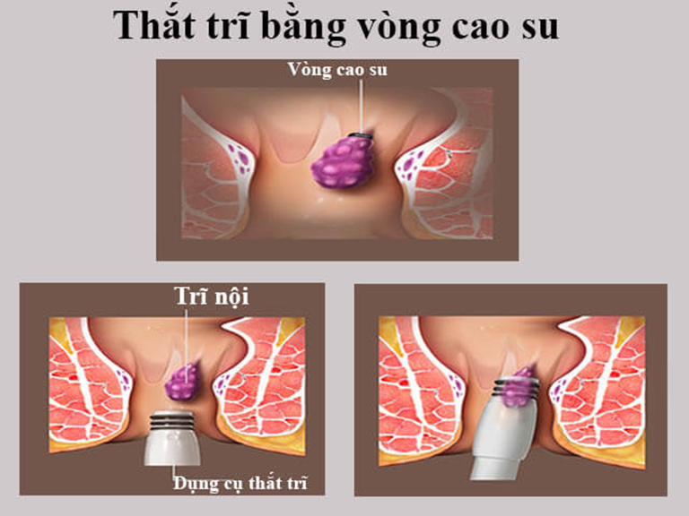 Thắt trĩ bằng vòng cao su là phương pháp hiệu quả được nhiều người áp dụng