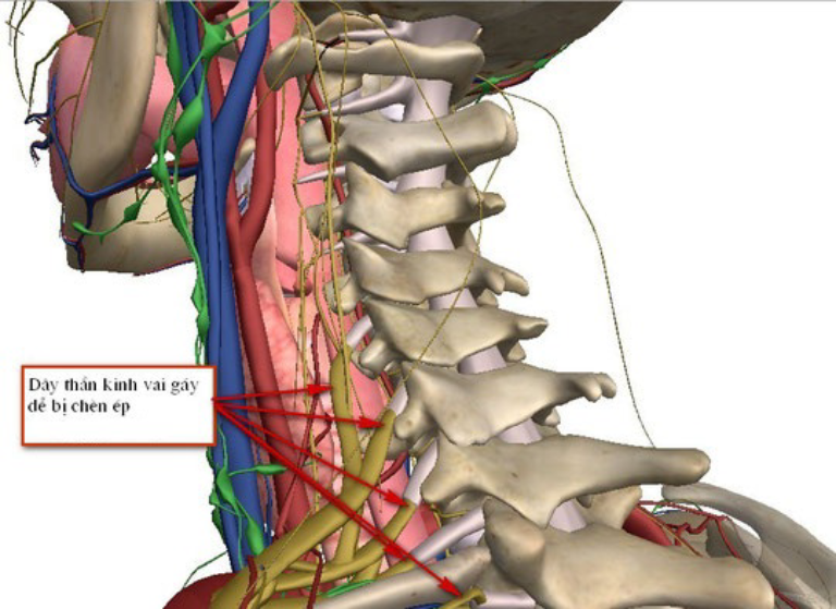 Khi bị chèn ép dây thần kinh cổ, quá trình cung cấp máu đến não không đủ sẽ gây ra hiện tượng rối loạn tuần hoàn não