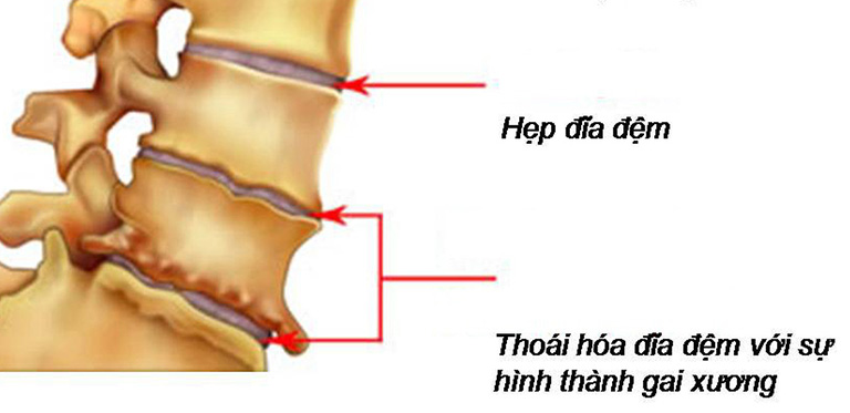 dấu hiệu thoái hóa cột sống thắt lưng