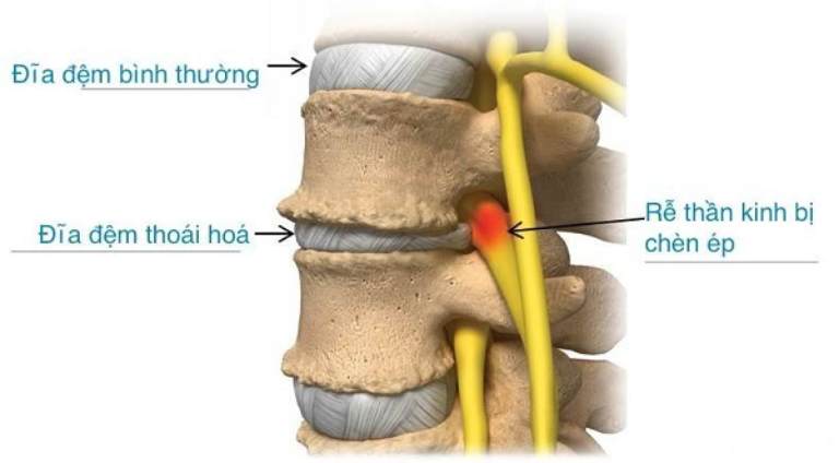 Đĩa đệm bị thoái hóa