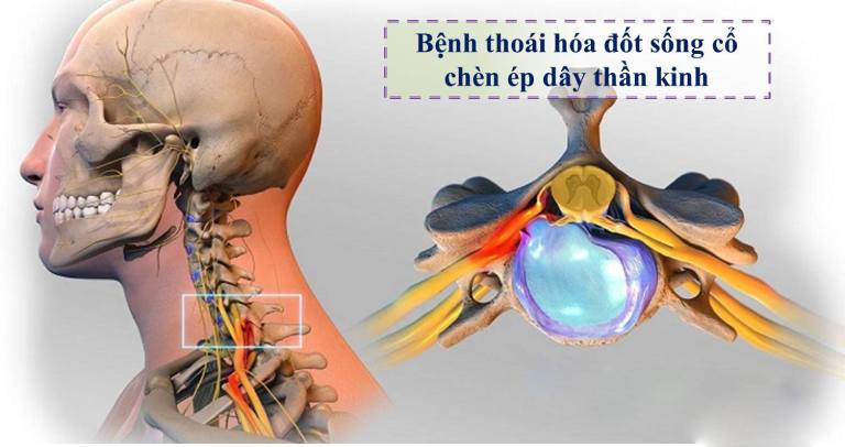 Bệnh thoái hóa đốt sống cổ chèn dây thần kinh