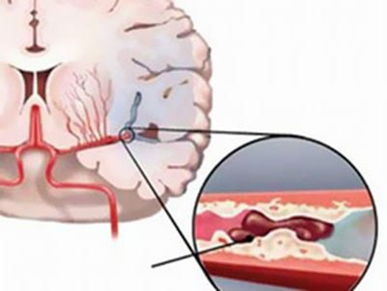 Các gai đốt sống gây chèn ép lên mạch máu, hạn chế lưu thông máu lên não gay đau đầu