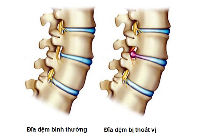 Thoát vị đĩa đệm cột sống thắt lưng