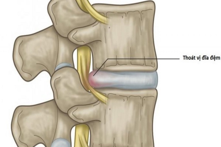 thoát vị đĩa đệm có ảnh hưởng đến sinh sản