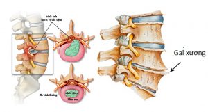 bệnh thoát vị đĩa đệm có nguy hiểm không