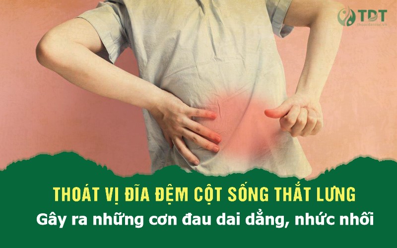 Triệu chứng thoát vị đĩa đệm cột sống thắt lưng