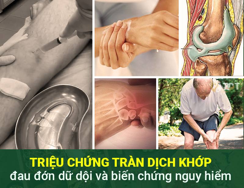 Tràn dịch khớp đau đớn dữ dội và biến chứng nguy hiểm