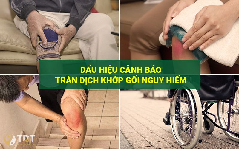 Dấu hiệu cảnh báo tràn dịch khớp gối nguy hiểm