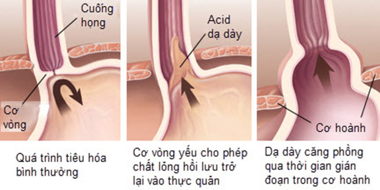 Axit trào ngược lên thực quản không chỉ ở dạ dày mà còn ở ruột non