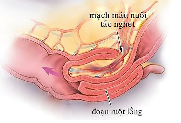 trẻ đi ngoài có chất nhầy và máu