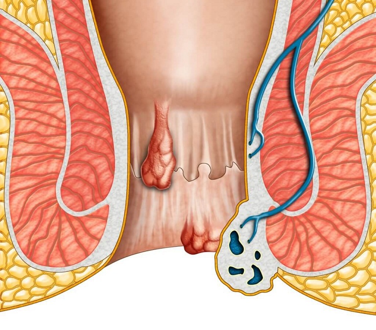 Trĩ ngoại có gây ung thư