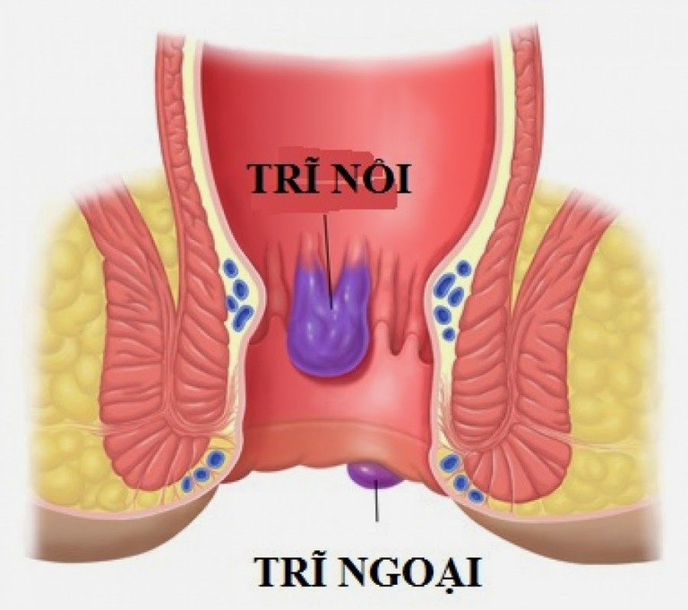 Trĩ nội nằm ở trên đường lược, trĩ ngoại thì nằm ở dưới