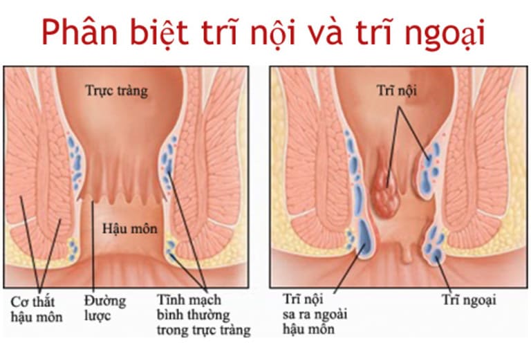 Trĩ nội nằm trong ống hậu môn. Trĩ ngoại thì nằm ở ngoài