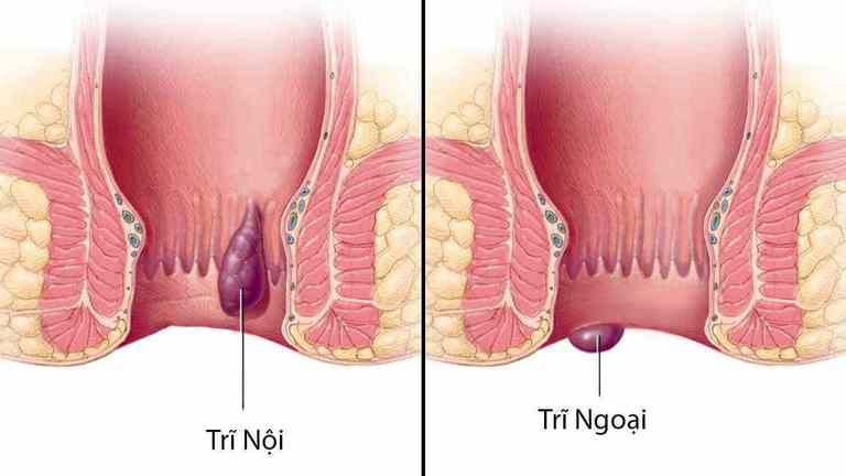 Trĩ nội khó phát hiện hơn trĩ ngoại