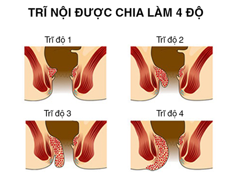 Các cấp độ của bệnh sa búi trĩ nội