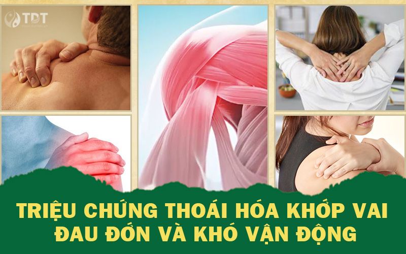 Biểu hiện của thoái hóa khớp vai