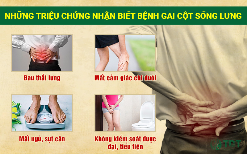 dấu hiệu gai cột sống lưng