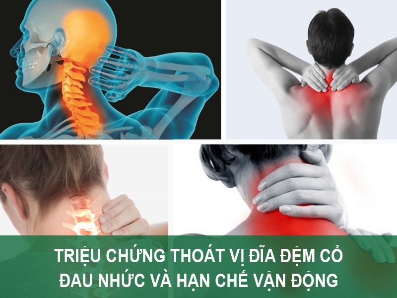 Triệu chứng Thoát vị đĩa đệm cổ