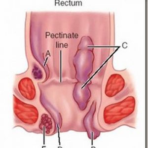 triệu chứng bệnh trĩ hỗn hợp