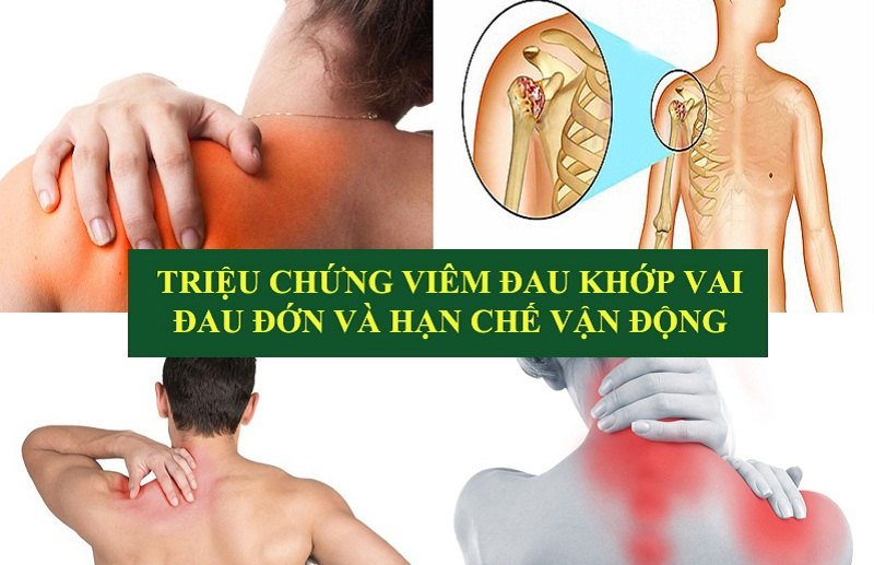 Triệu chứng viêm đau khớp vai