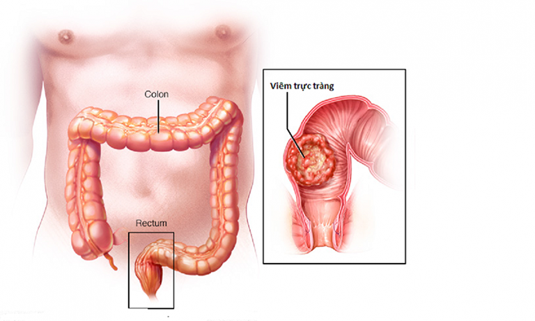 Người bị viêm trực tràng có các dấu hiệu nào?