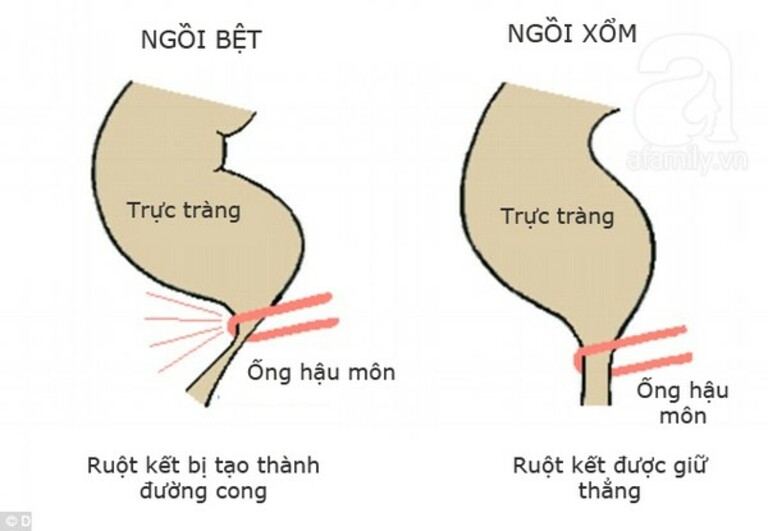 Ruột kết khi đi vệ sinh kiểu ngồi bệt và ngồi xổm