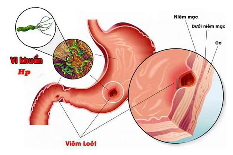 Vi khuẩn HP là một trong những thủ phạm chính gây bệnh viêm loét dạ dày