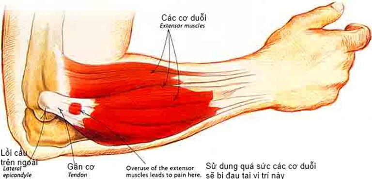 Bệnh viêm lồi cầu xương ngoài cánh tay là tình trạng viêm các gân cơ duỗi