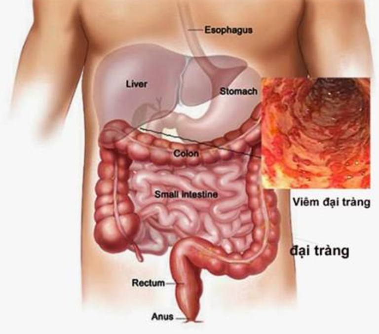 Đau bụng trên rốn là tiệu chứng thường gặp của bệnh viêm tá tràng