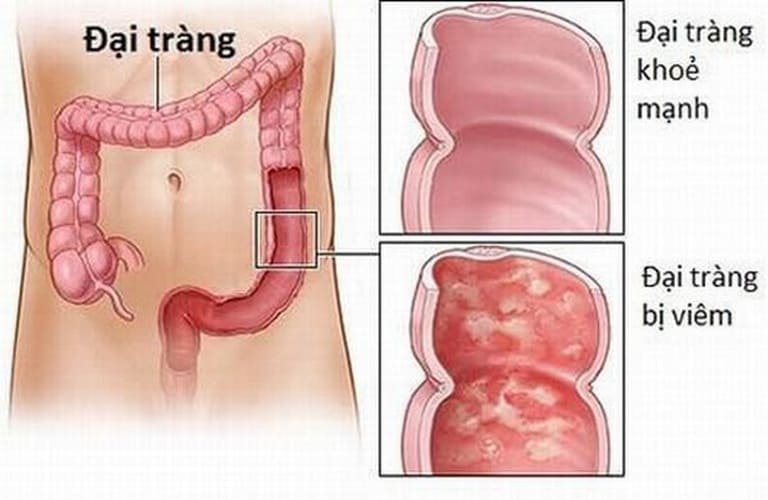 Viêm đại tràng khá phổ biến trong các bệnh về hệ tiêu hóa nhưng không nhiều người biết đại tràng là tên gọi khác của ruột già